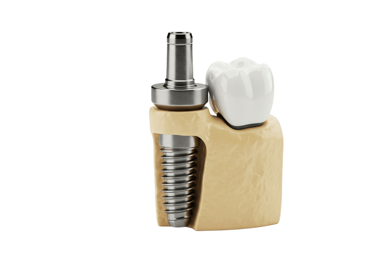 dental implants in philadelphia
