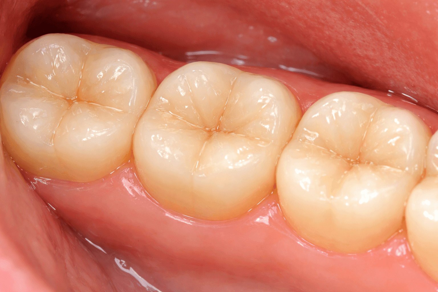 Tooth Colored Fillings in Philadelphia