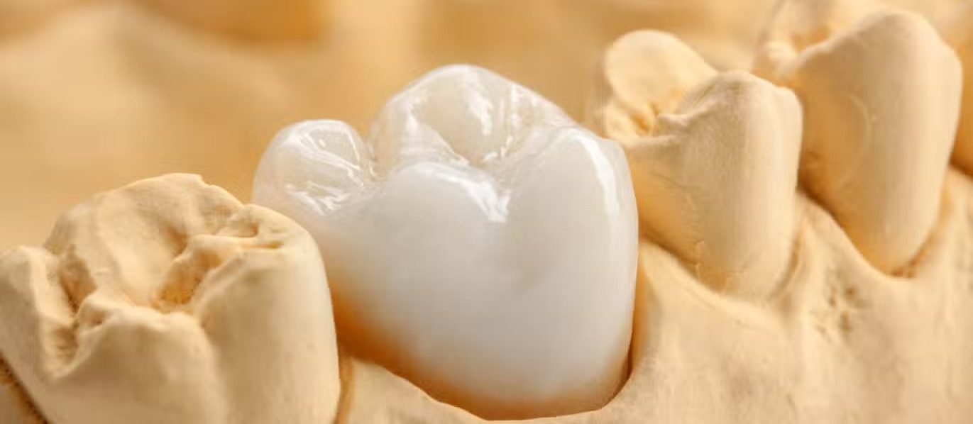 Types of Dental Crowns