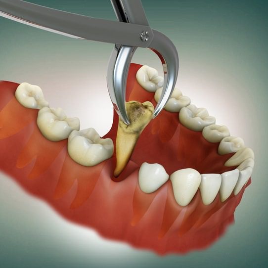 tooth extraction Philadelphia