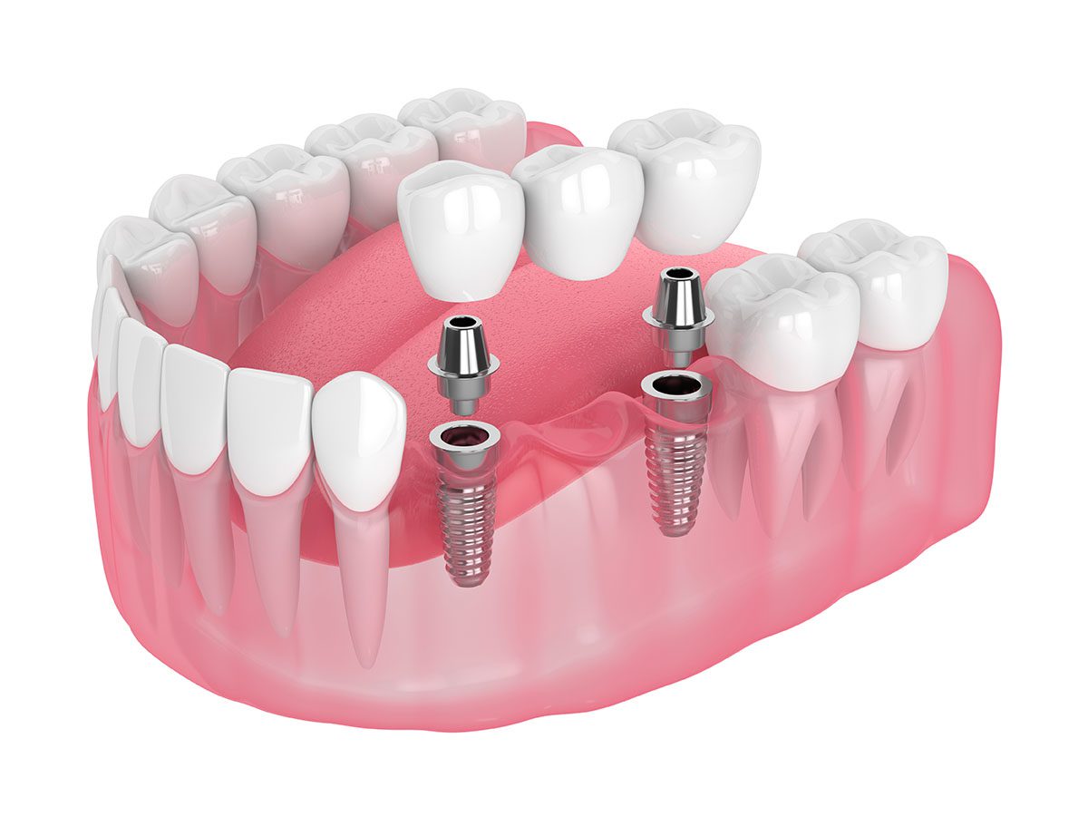 multiple dental implants philadelphia