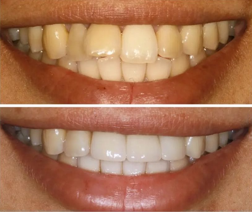 veneers before and after philadelphia