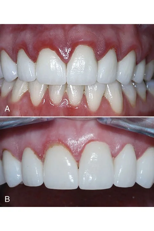 Gingivectomy