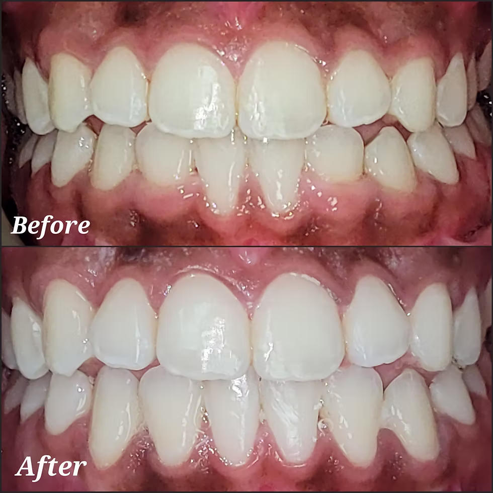 Gingivectomy