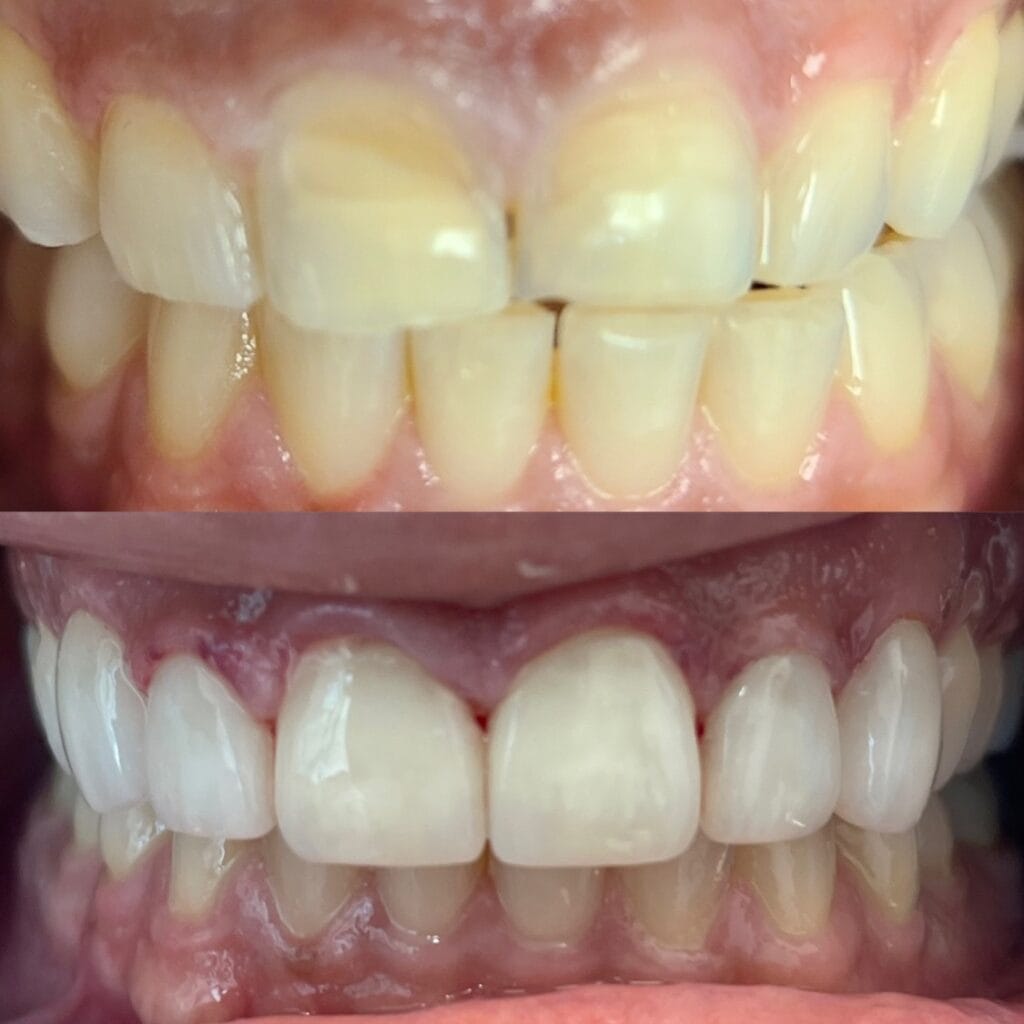 veneer before and after leily razavi
