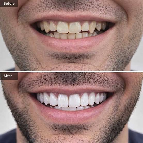 porcelain veneers before and after razavi dental