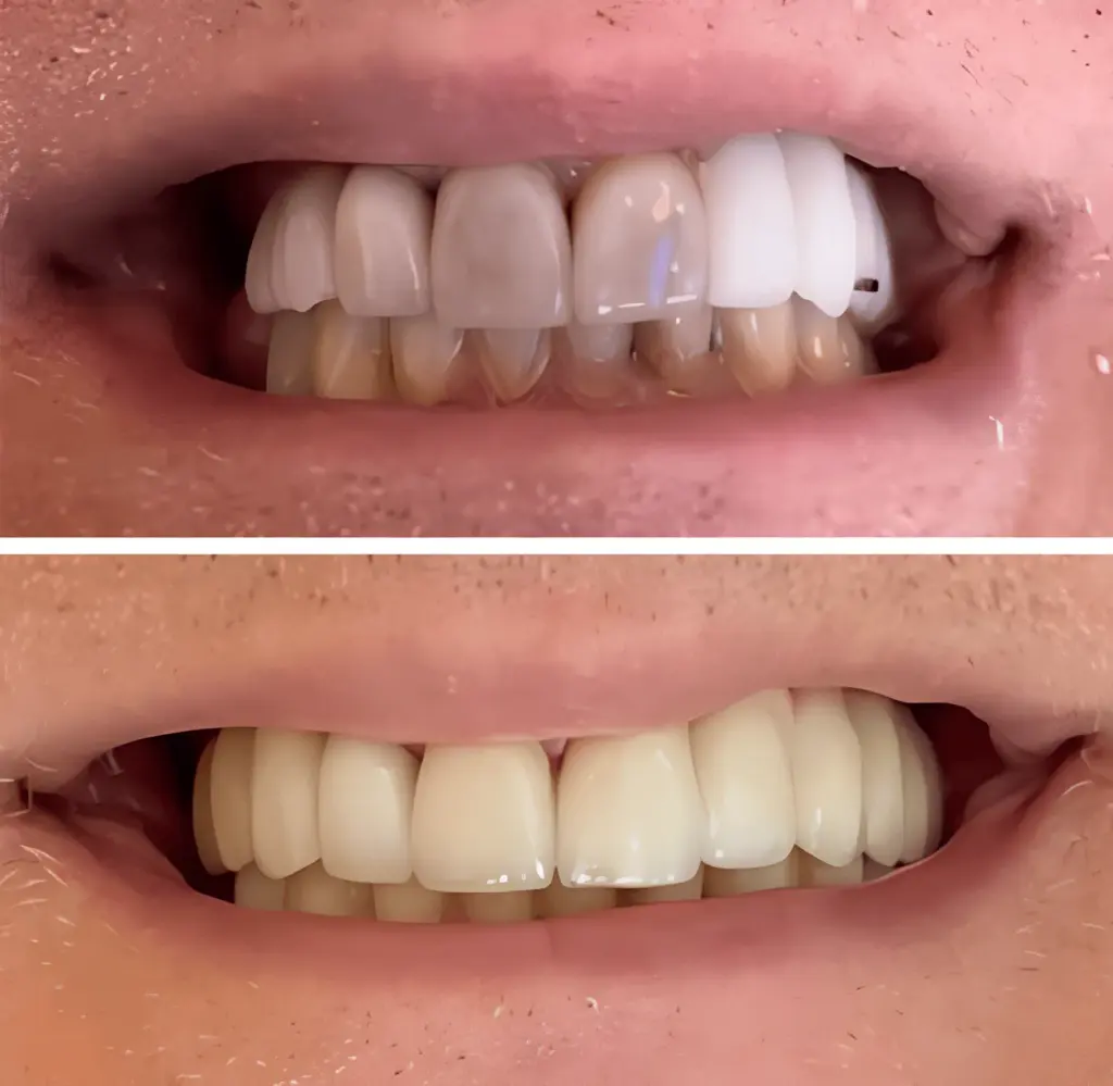 veneer smile transformation philadelphia