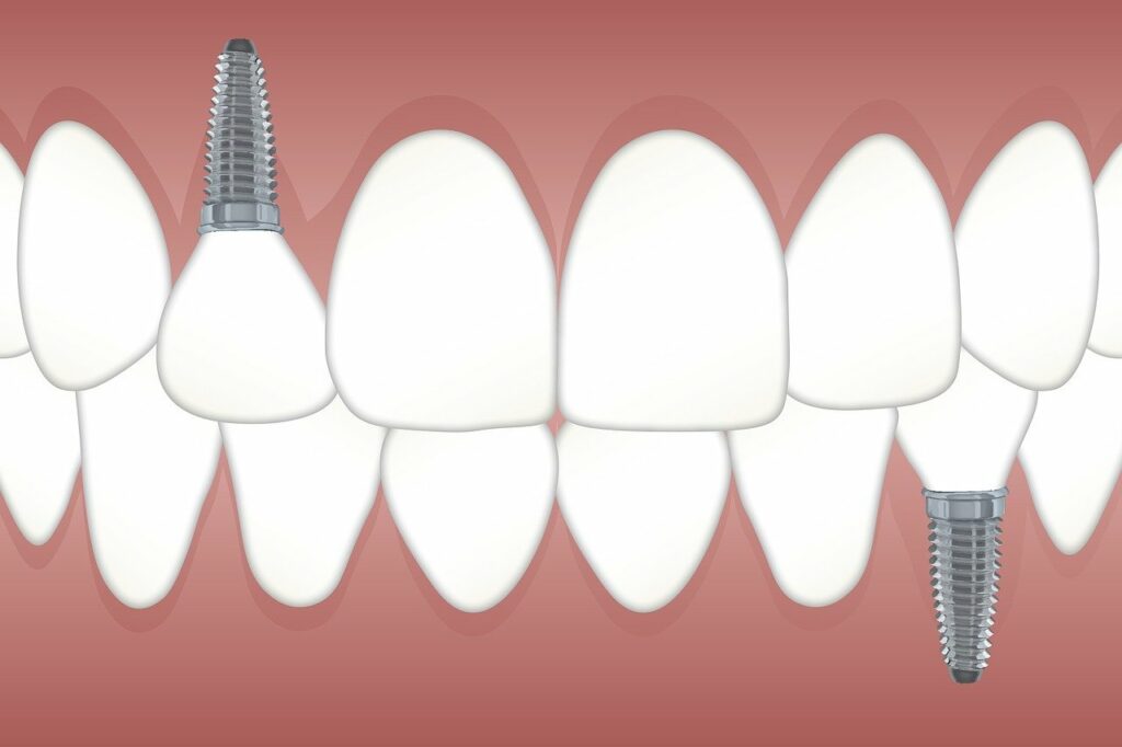 dental implants in Philadelphia